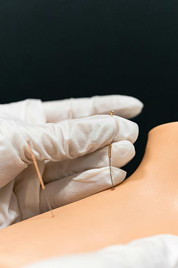 acupuncture, needle technique, alternative therapy, close-up, skin, model, foot acupuncture, demonstration, therapy session, gloves, health