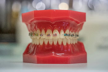model of jaw, teeth braces, dental care, orthodontics, colorful braces, human teeth, dental model, orthodontic treatment, dental braces model, dental education, braces photo