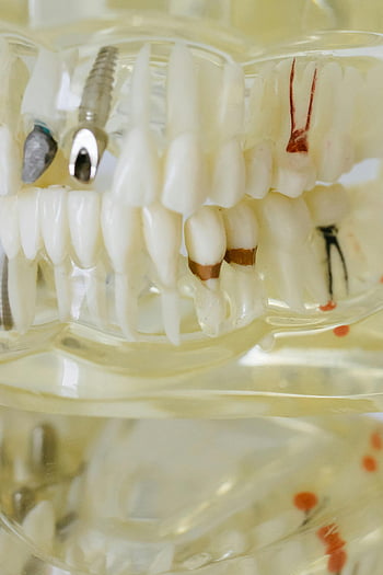tandheelkundig model, close-up fotografie, Tandheelkundige implantaten, vullingen, Orthodontische kenmerken, Ziekte tandheelkundige tanden, gedetailleerde close-up, tandheelkundige gezondheid, tandartsopleiding, tandanatomie, tandprotheses