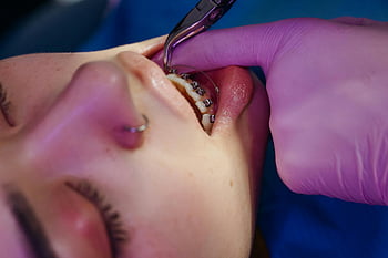dentist examining teeth, close-up dental procedure, braces on teen, dental braces, teen dental care, dental examination, close-up teeth, dental treatment, orthodontic treatment, dental health, teen braces