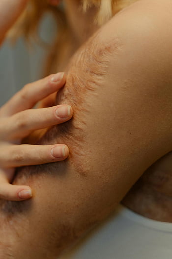 피부 질감, 자연 흉터, 팔 클로즈업, 신체 양성, 자세한 견해, 피부 결함, 흉터 가시성, 인간의 피부, 팔 흉터, 피부 건강, 흉터 치유